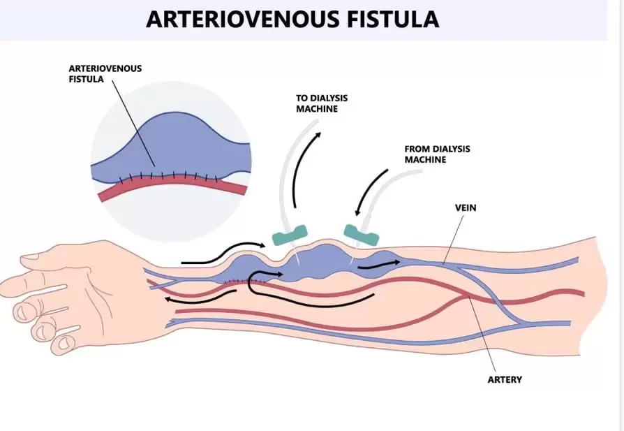 Arteriovenous (AV) fistulas — a surgical connection between an artery and a vein